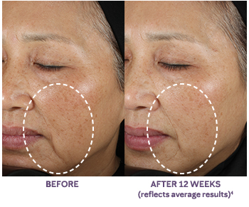 Close-up images show a woman’s cheek and mouth area before using the new TimeWise Repair Volu-Firm Advanced Lifting Serum from Mary Kay and after using the product for 12 weeks. 