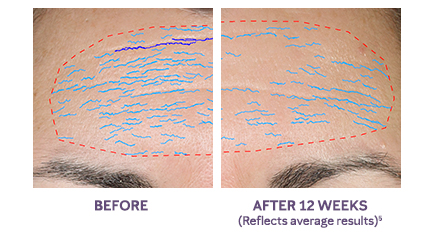 Close-up images show average results on a woman’s forehead area before using the new TimeWise Repair Volu-Firm Advanced Lifting Serum from Mary Kay and after using the product for 12 weeks. 