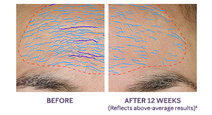 Close-up images show above-average results on a woman’s forehead area before using the new TimeWise Repair Volu-Firm Advanced Lifting Serum from Mary Kay and after using the product for 12 weeks. 
