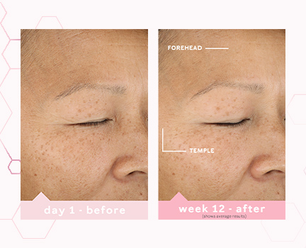 Day 1 and week 12 before and after images showing average skin improvement on the forehead and temple after using TimeWise Miracle Set