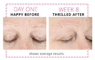 Before and after images showing average improvement between the brows after eight weeks of using Dynamic Wrinkle Limiter