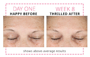 Before and after images showing above average improvement to forehead area after eight weeks of using Dynamic Wrinkle Limiter