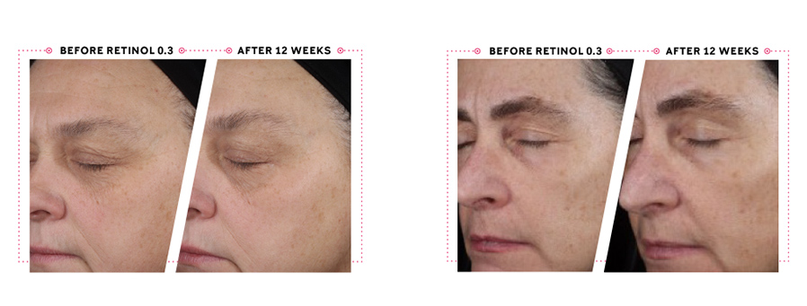 Before and after images demonstrate average visible improvement in deep lines, blotchiness, wrinkles and radiance after using Retinol 0.3 nightly for 12 weeks